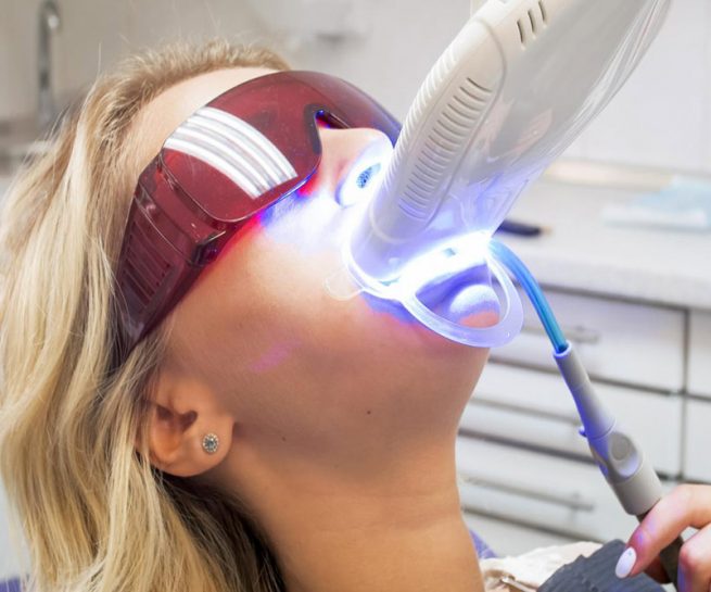 blanqueamiento-dental-en-lima1