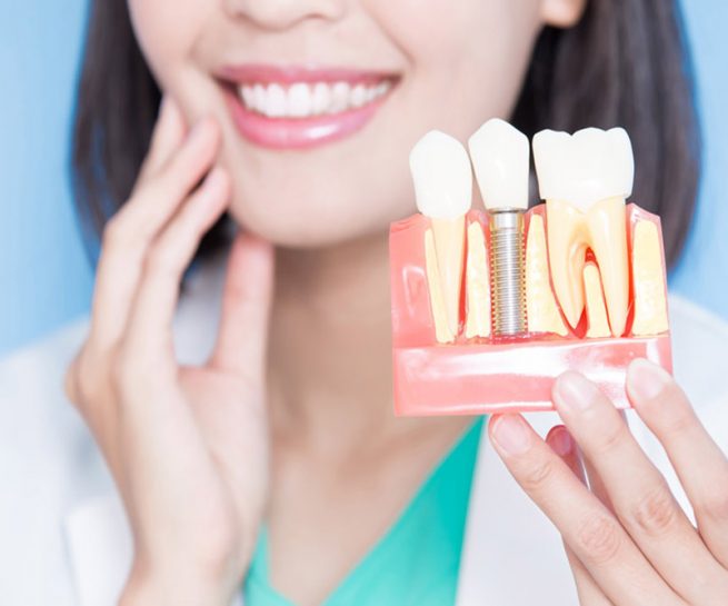 implantes-dentales-en-lima