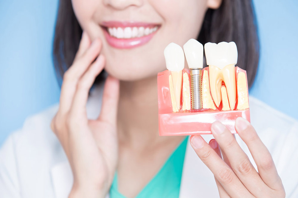 implantes-dentales-en-lima