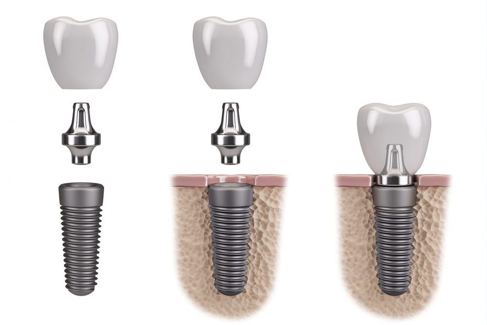 implantes-dentales-en-lima2