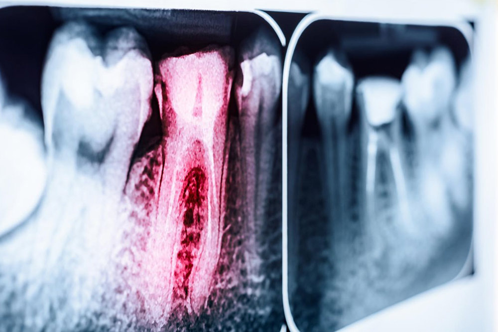 radiografias-dientes